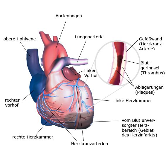 Was ist ein Herzinfarkt