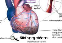 Was ist ein Herzinfarkt?